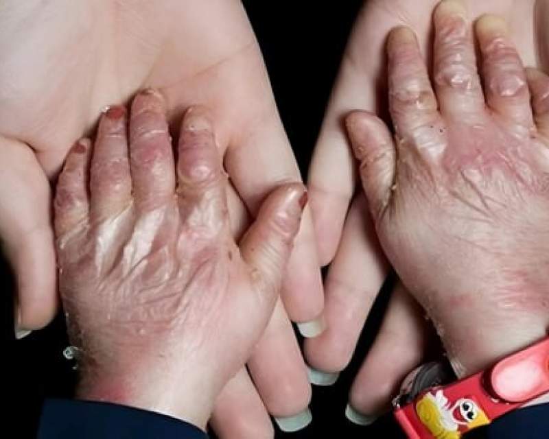 ️تحویل پانسمان‌های جدید برای ۱۰۰۰ بیمار پروانه‌ای از سوی دانشگاه علوم پزشکی ایران