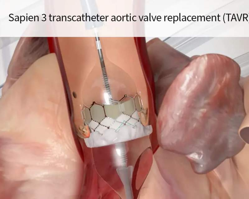 درمان TAVR ادواردز لایف ساینسز برای بیماران مبتلا به تنگی شدید آئورت بدون علامت تائیدیه FDA را گرفت