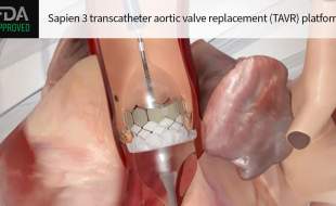 درمان TAVR ادواردز لایف ساینسز برای بیماران مبتلا به تنگی شدید آئورت بدون علامت تائیدیه FDA را گرفت