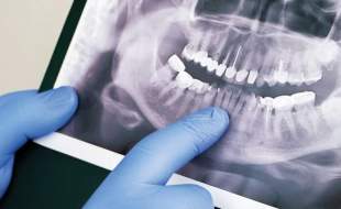 توسعه سامانه هوشمند تحلیل تصاویر دندانپزشکی توسط پژوهشگران دانشگاه تهران