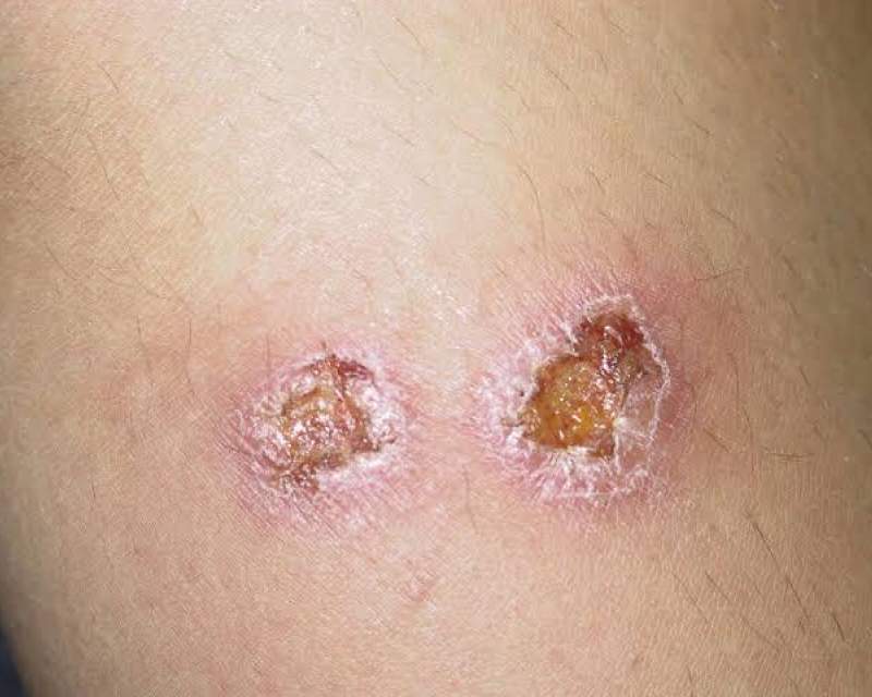 نخستین باند تخصصی درمان زخم سالک توسط محققان کاشانی تولید شد نخستین باند تخصصی درمان زخم سالک توسط محققان کاشانی تولید شد