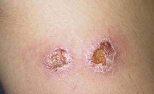 نخستین باند تخصصی درمان زخم سالک توسط محققان کاشانی تولید شد