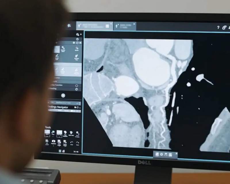 بهبود مدیریت بیماری عروق کرونر با نرمافزار جدید زیمنس هلثینرز بهبود مدیریت بیماری عروق کرونر با نرمافزار جدید زیمنس هلثینرز