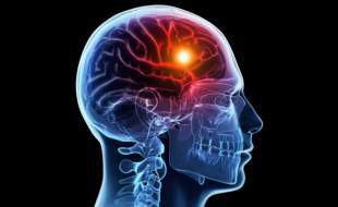 تغییر نرخ ارز درمان نوپای سکته مغزی دچار مشکل کرده است