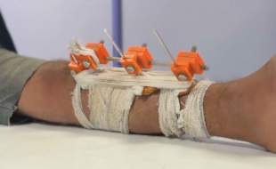 پزشکان غزه با چاپ سه‌بعدی از قطع عضو جلوگیری می‌کنند