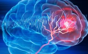 افزایش ۱۰ برابری تجهیزات درمان سکته مغزی