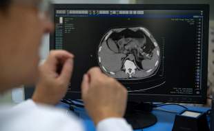 هوش مصنوعی چینی‌ها، سرطان پانکراس را زودتر از بروز علائم کشف می‌کند