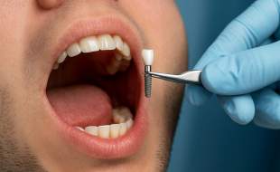 قیمت‌های واقعی متریال و تجهیزات دندانپزشکی