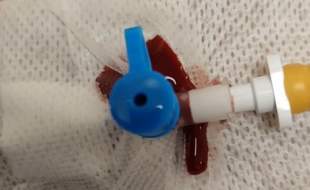 آنژیوکت‌های بی‌کیفیت وارداتی بلای جان بیماران تالاسمی